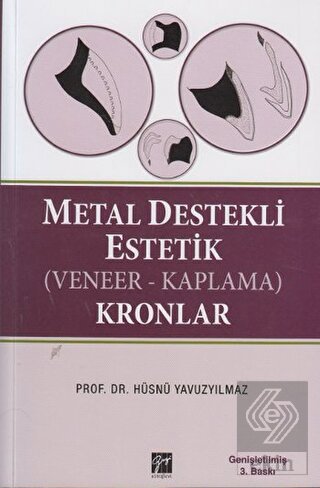 Metal Destekli Estetik (Veneer-Kaplama)Kronlar